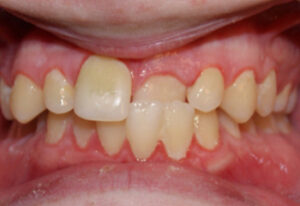 Orthodontic Before & After Photo