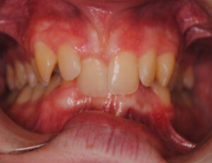 Orthodontic Before & After Photo