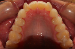 Orthodontic Before & After Photo