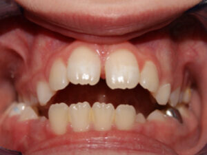 Orthodontic Before & After Photo