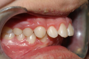 Orthodontic Before & After Photo