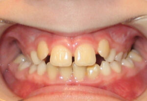 Orthodontic Before & After Photo