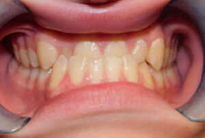 Orthodontic Before & After Photo